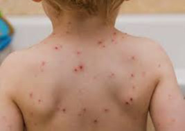 Дархан-Уул аймагт менингококкт өвчний тохиолдол бүртгэгджээ